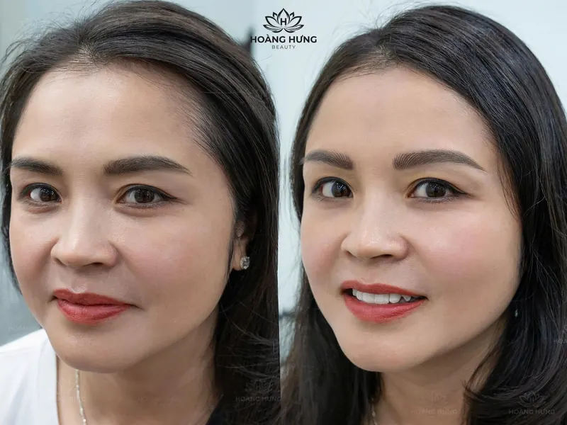 Trước và sau chỉnh sửa dáng mày lệch — khách 1
