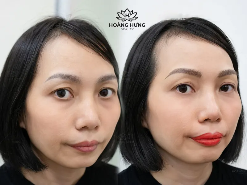 Khách hàng trước và sau khi làm đẹp tại Hoàng Hưng Beauty