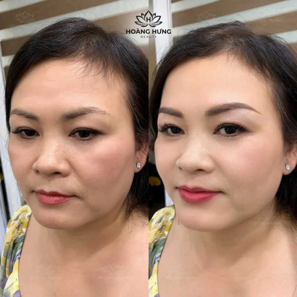 Khách hàng trước và sau khi xoá sửa chân mày tại Hoàng Hưng Beauty